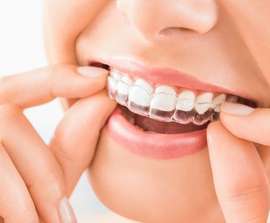 TEETH STRAIGHTENING