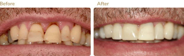 Before and after smile transformation 2