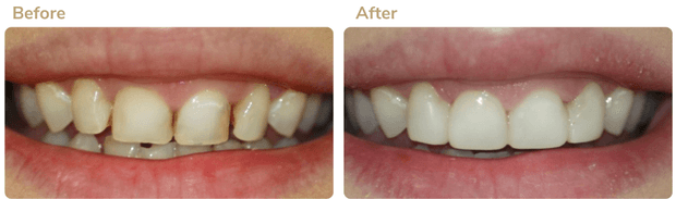 Before and after smile transformation 3