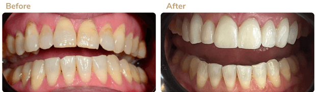 Before and after smile transformation 1